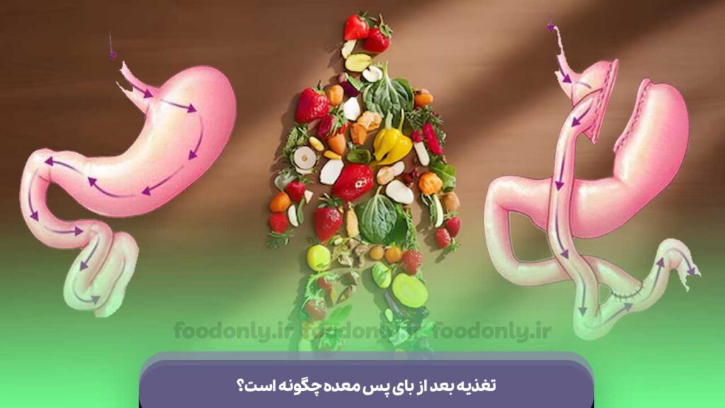 تغذیه بعد از بای پس معده