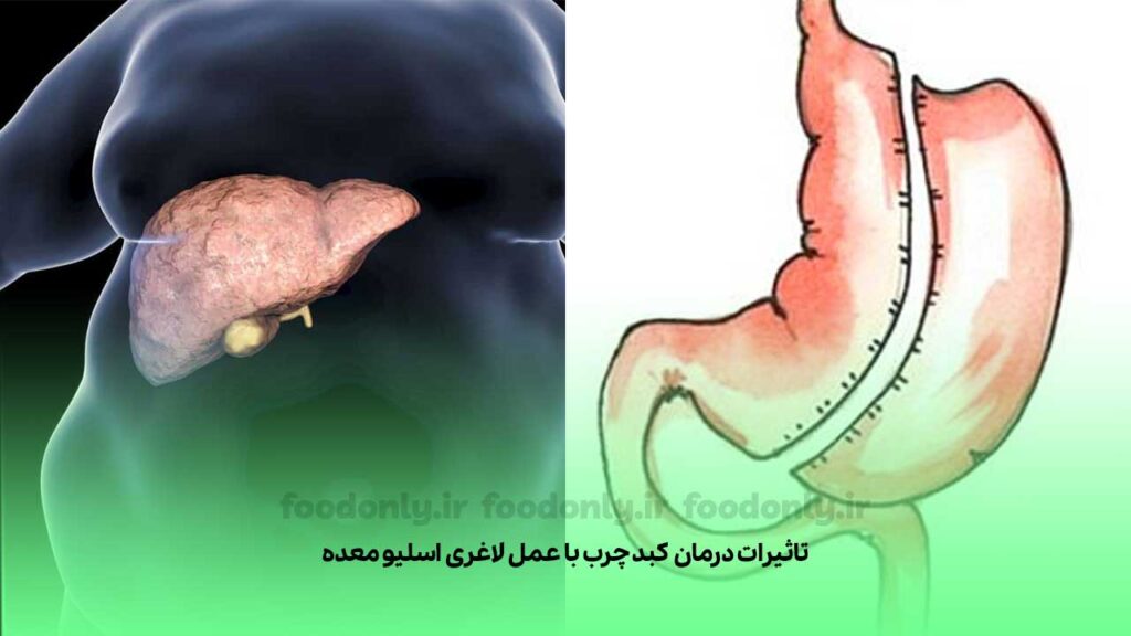 تاثیرات درمان کبد چرب با عمل لاغری اسلیو معده