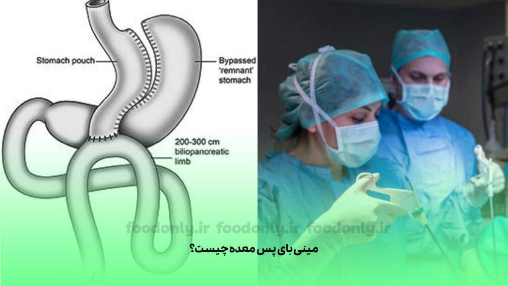 مینی بای پس معده چیست؟